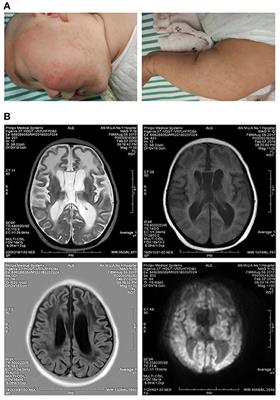 Case Report: Aicardi-Goutières Syndrome Caused by Novel TREX1 Variants